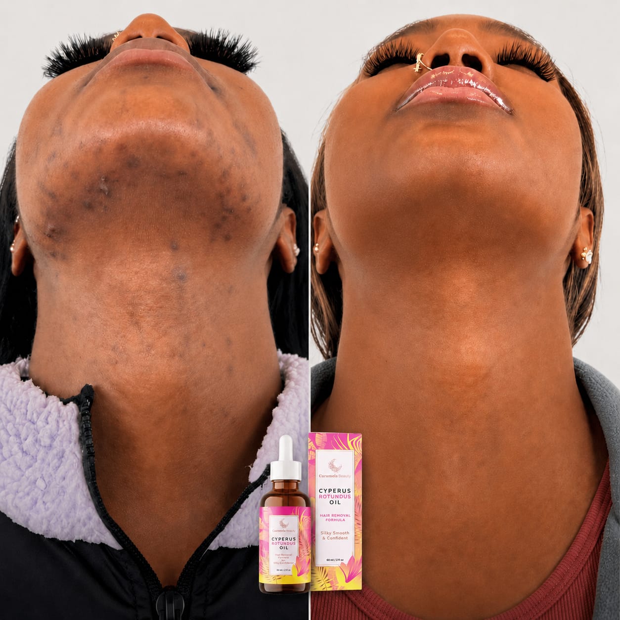 Chin and neck skin before and after